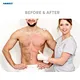 hair removal for clinics